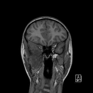 Base of skull rhabdomyosarcoma (Radiopaedia 32196-33142 Coronal T1 11).jpg