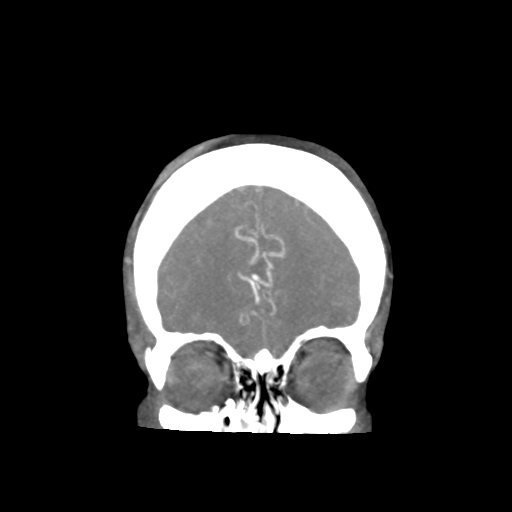 Basilar and bilateral vertebral artery occlusion (Radiopaedia 45592-49723 B 21).png
