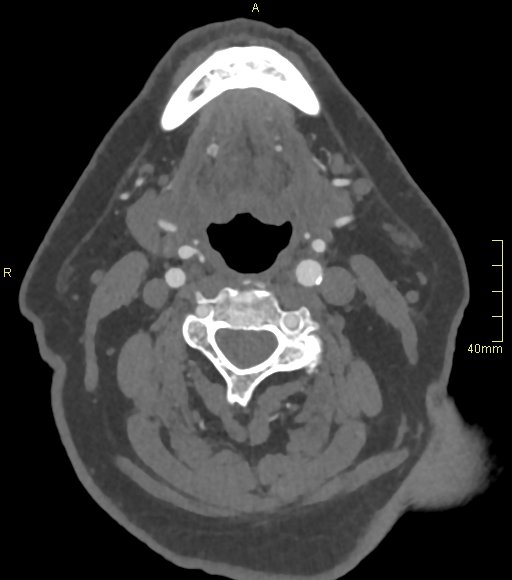 Basilar artery aneurysm (Radiopaedia 56261-62932 A 2).jpg