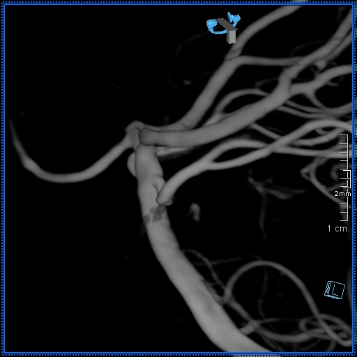 Basilar artery perforator aneurysm (Radiopaedia 82455-99524 3D Left VA 24).jpg