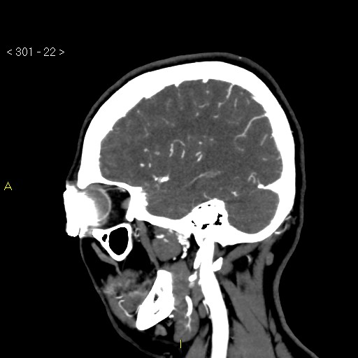 File:Basilar artery thrombosis (Radiopaedia 16260-15944 C 16).jpg