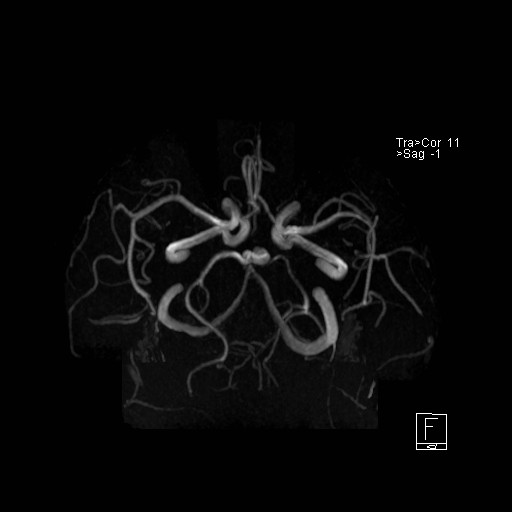 Basilar tip aneurysm (Radiopaedia 26504-26632 D 9).jpg