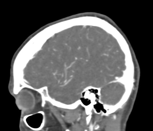 Basilar tip aneurysm with coiling (Radiopaedia 53912-60086 C 24).jpg