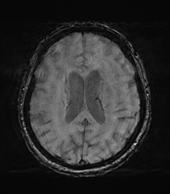 File:Behavioral variant frontotemporal dementia and late onset schizophrenia (Radiopaedia 52197-58083 Axial SWI 46).png