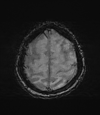 File:Behavioral variant frontotemporal dementia and late onset schizophrenia (Radiopaedia 52197-58083 Axial SWI 65).png