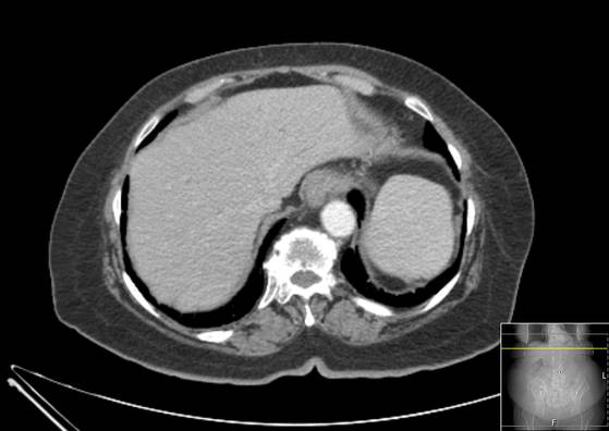 Bicameral celiacomesenteric aneurysm (Radiopaedia 55766-62327 A 7).jpg