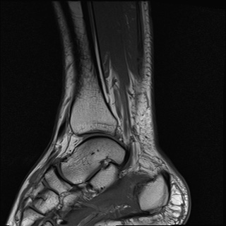File:Bilateral Achilles tendon complete tear (Radiopaedia 81344-95051 Sagittal T1 20).jpg
