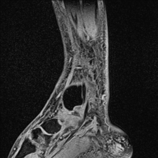 File:Bilateral Achilles tendon complete tear (Radiopaedia 81344-95051 Sagittal WE - Right 82).jpg