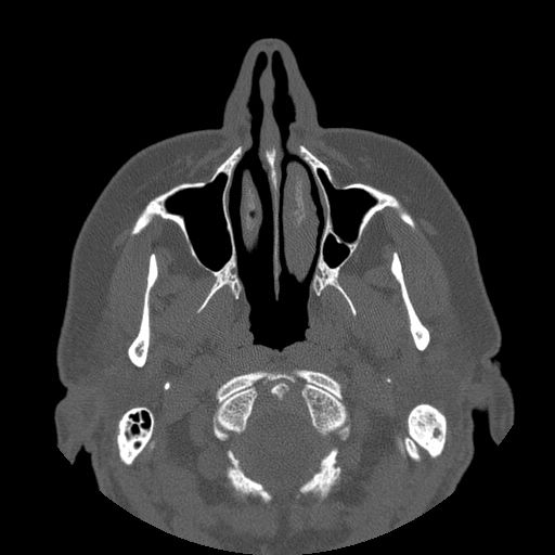 File:Bilateral Ectopic Infraorbital Nerves (Radiopaedia 49006-54084 Axial bone window 5).jpg