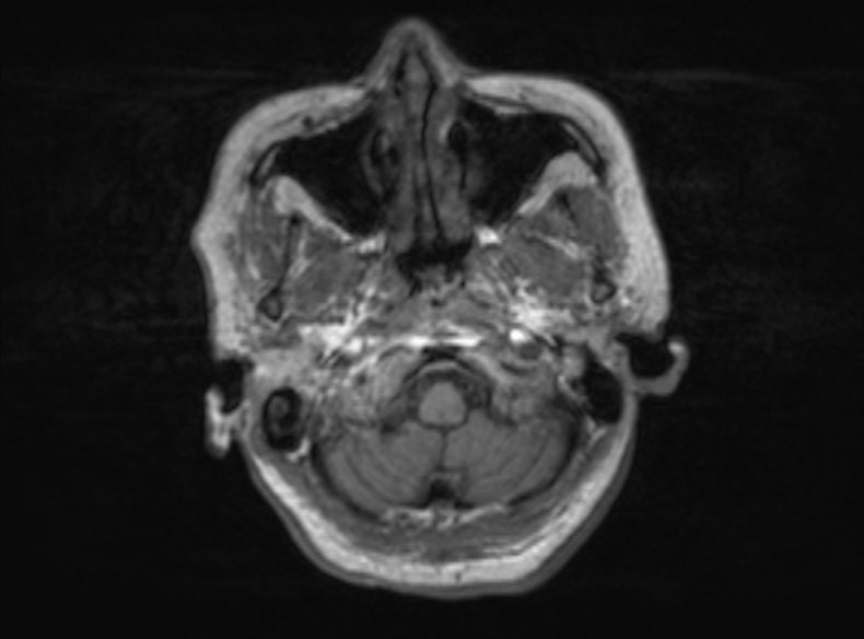 Bilateral PCA territory infarction - different ages (Radiopaedia 46200-51784 Axial T1 341).jpg
