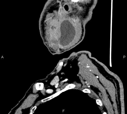 Bilateral Warthin tumors (Radiopaedia 84034-99263 D 19).jpg