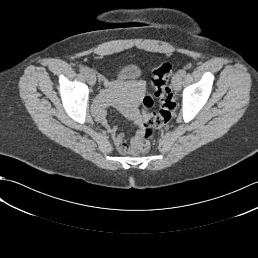 Bilateral acetabular protrusion with pincer type femoro-acetabular impingement (Radiopaedia 30134-30733 AXIAL SOFT THIN 14).jpg