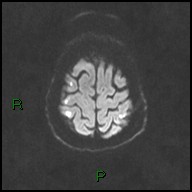 File:Bilateral acute middle cerebral artery territory infarcts (Radiopaedia 77319-89402 Axial DWI 45).jpg