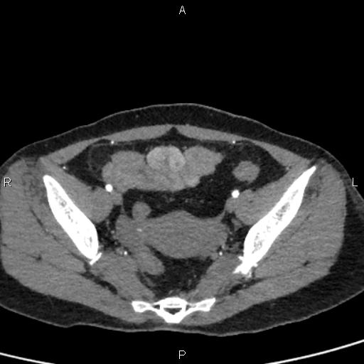 Bilateral adrenal gland hyperenhancement in pancreatitis (Radiopaedia 86642-102753 B 108).jpg