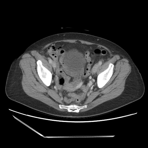 Bilateral adrenal granulocytic sarcomas (chloromas) (Radiopaedia 78375-91007 A 100).jpg