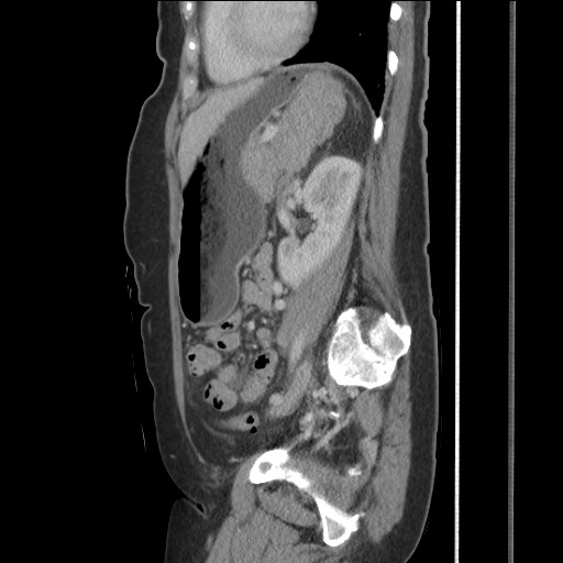Bilateral adrenal granulocytic sarcomas (chloromas) (Radiopaedia 78375-91007 C 92).jpg