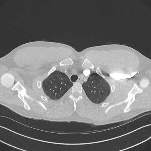 File:Bilateral atelectasis (Radiopaedia 48666-53675 Axial lung window 14).jpg