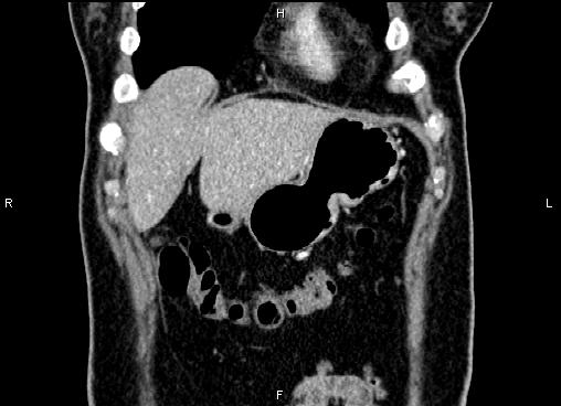 Bilateral benign adrenal adenomas (Radiopaedia 86912-103124 D 8).jpg