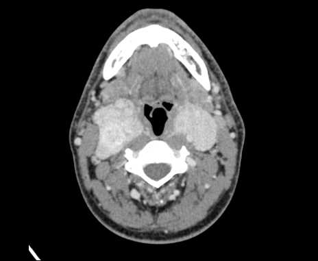 Bilateral carotid body tumors (Radiopaedia 61841-69870 Axial Post contrast 46).jpg