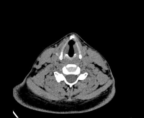Bilateral carotid body tumors (Radiopaedia 61841-69870 Axial non-contrast 74).jpg