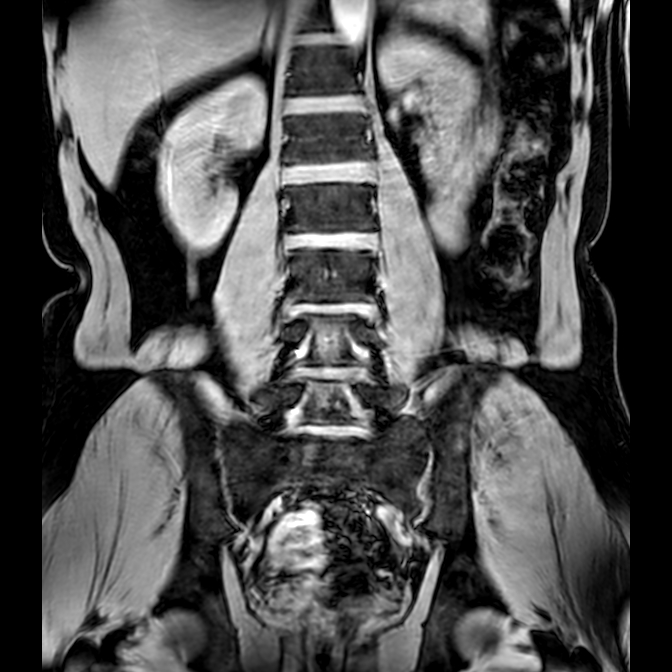 Bilateral conjoined nerve roots at different levels (Radiopaedia 73312-84063 Coronal WE 27).jpg