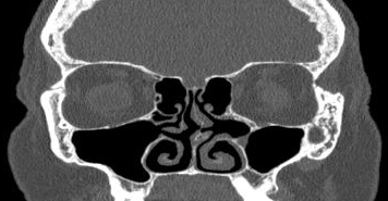 File:Bilateral ectopic infraorbital nerves (Radiopaedia 49006-54084 Coronal 38).png
