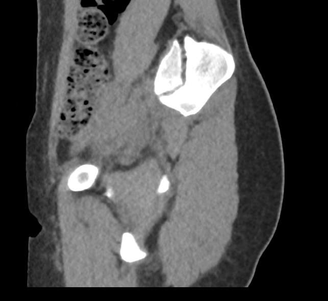 Bilateral mature cystic ovarian teratoma (Radiopaedia 88821-105592 D 6).jpg