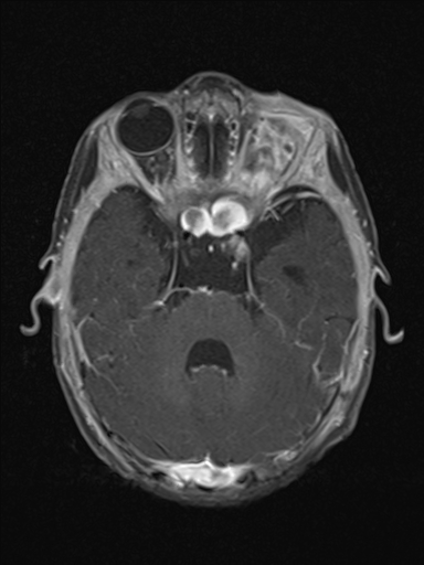 File:Bilateral optic pathway gliomas (Radiopaedia 40013-42514 Axial T1 C+ fat sat 5).jpg