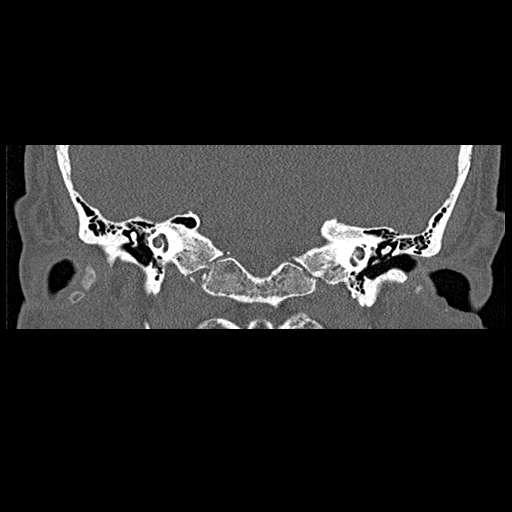 File:Bilateral ossifications of the external auditory canal (Radiopaedia 15233-15076 Coronal bone window 9).jpg