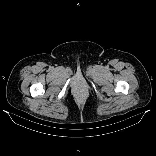 Bilateral ovarian dermoid cysts (Radiopaedia 85785-101603 Axial C+ delayed 97).jpg