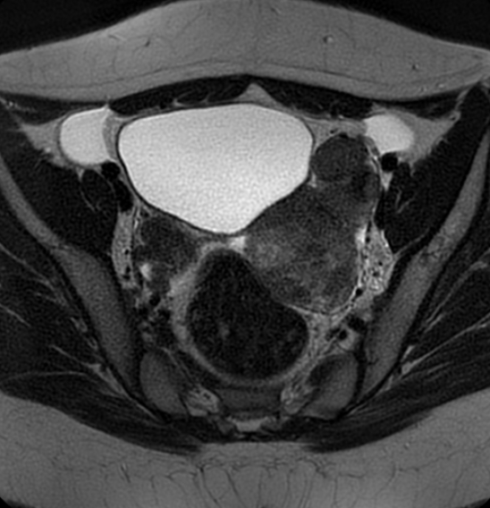 File:Bilateral ovarian fibrothecomas - adolescent (Radiopaedia 86604-102707 Axial T2 20).jpg