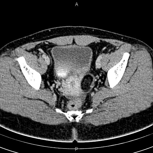 File:Bilateral ovarian teratoma (Radiopaedia 83131-97503 B 49).jpg