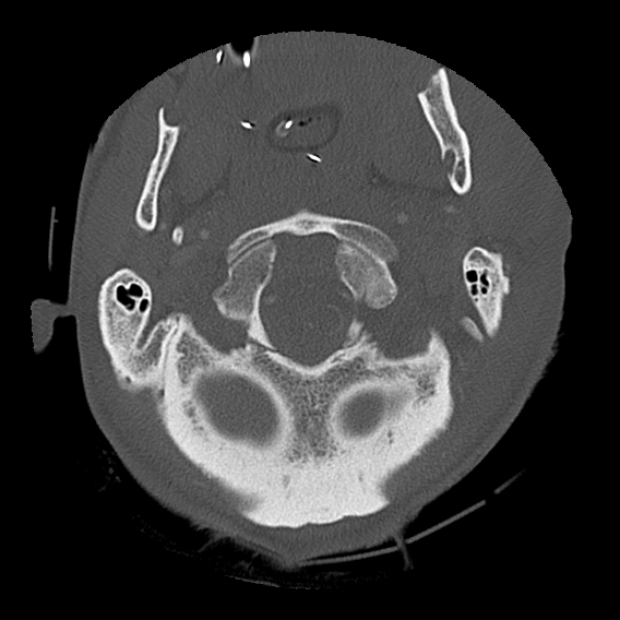 Bilateral perched facets with cord injury (Radiopaedia 45587-49713 Axial bone window 22).jpg