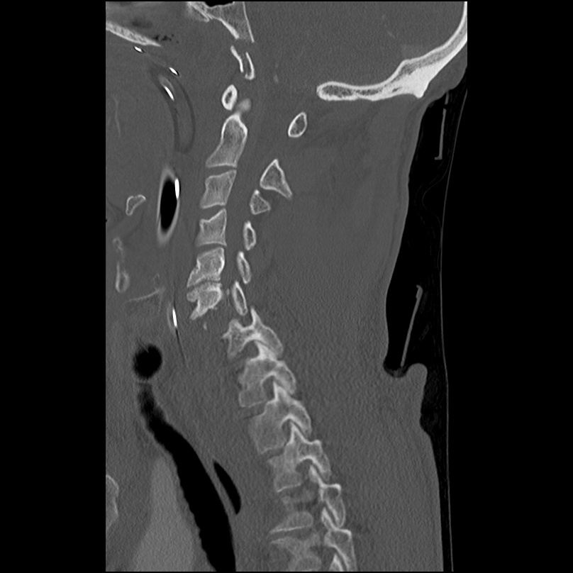 Bilateral perched facets with cord injury (Radiopaedia 45587-49713 Sagittal bone window 21).jpg