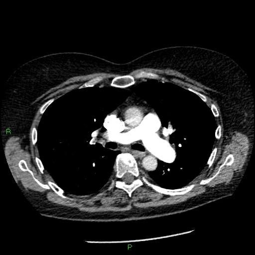 Bilateral pulmonary emboli (Radiopaedia 32700-33669 Axial C+ CTPA 45).jpg