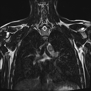 Bilateral spinoglenoid notch ganglion cysts (Radiopaedia 29577-30082 Coronal T2 76).jpg