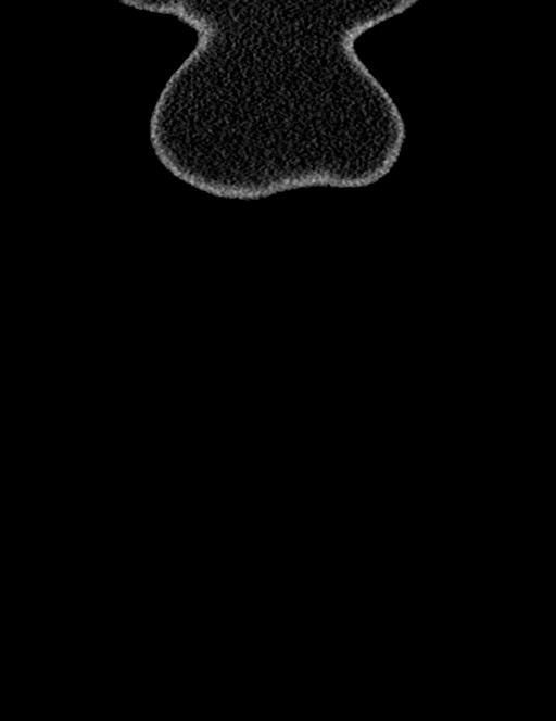 Bilateral staghorn calculi (Radiopaedia 59475-66842 Coronal non-contrast 21).jpg
