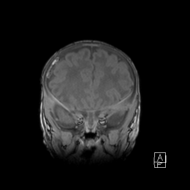 Bilateral subdural hemorrhage and parietal skull fracture (Radiopaedia 26058-26190 Coronal T1 15).png