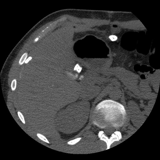 Bile leak from liver traumatic laceration (Radiopaedia 63463-72077 Axial Biliscopin 43).jpg