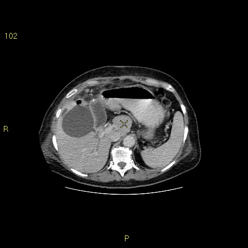 File:Biloma with drainage into the colon (Radiopaedia 20032-20068 A 9).jpg