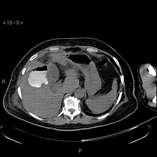 File:Biloma with drainage into the colon (Radiopaedia 20032-20068 B 3).jpg