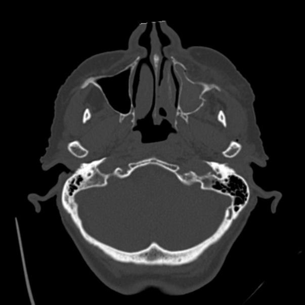 Biparietal osteodystrophy (Radiopaedia 46109-50463 bone window 13).jpg