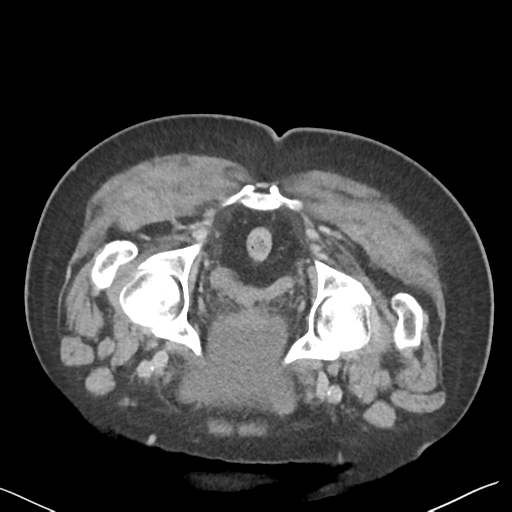 File:Bladder papillary urothelial carcinoma (Radiopaedia 48119-52951 Axial C+ delayed 56).png