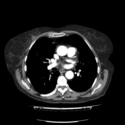 File:Bladder tumor detected on trauma CT (Radiopaedia 51809-57609 A 51).jpg