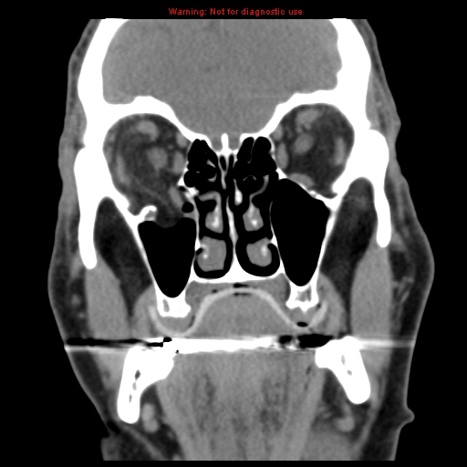 File:Blowout fracture with inferior rectus entrapment (Radiopaedia 12418-12673 Coronal non-contrast 12).jpg