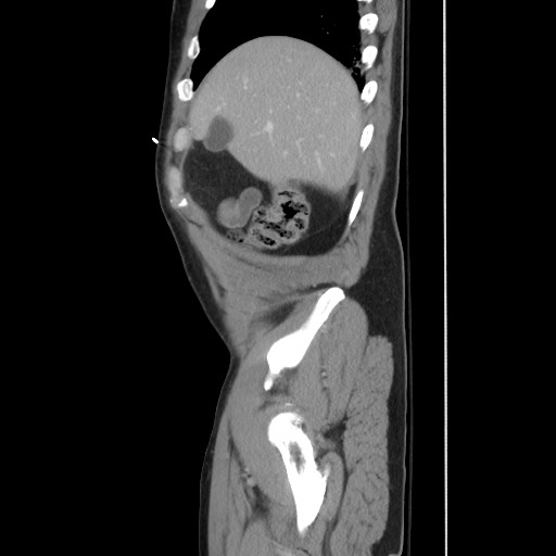 File:Blunt abdominal trauma with solid organ and musculoskelatal injury with active extravasation (Radiopaedia 68364-77895 C 35).jpg