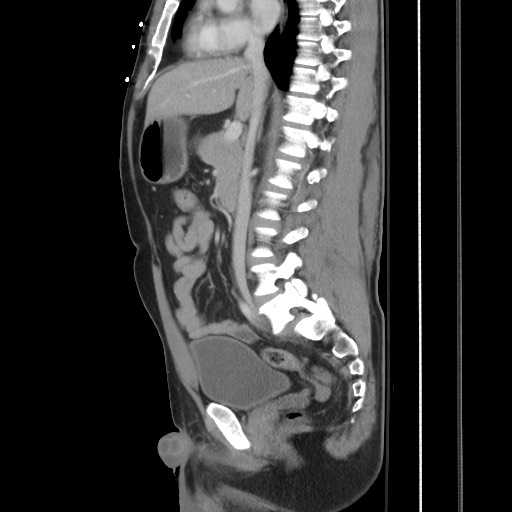 Blunt abdominal trauma with solid organ and musculoskelatal injury with active extravasation (Radiopaedia 68364-77895 C 69).jpg