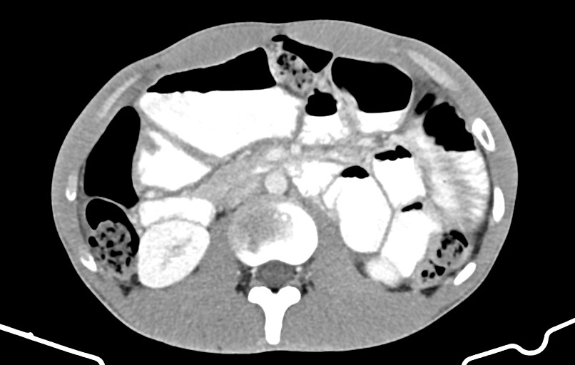 Blunt injury to the small bowel (Radiopaedia 74953-85987 A 70).jpg