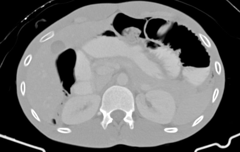 Blunt injury to the small bowel (Radiopaedia 74953-85987 Axial Wide 21).jpg