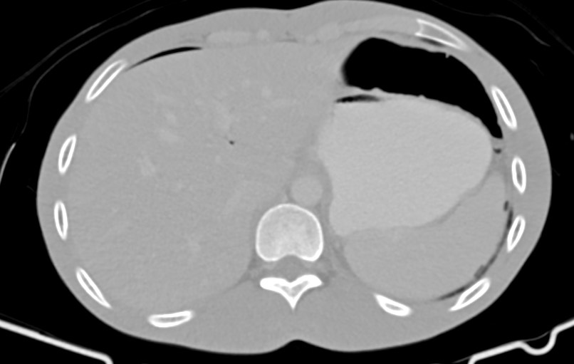 Blunt injury to the small bowel (Radiopaedia 74953-85987 Axial Wide 9).jpg